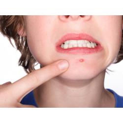 ACNE AWAY Laser