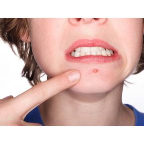 ACNE AWAY Laser