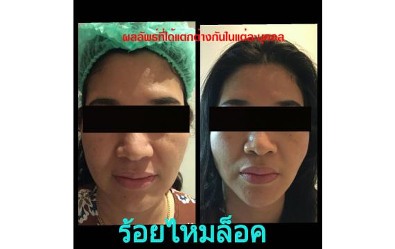 Before / After