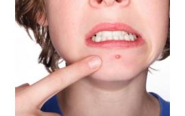 ACNE AWAY Laser
