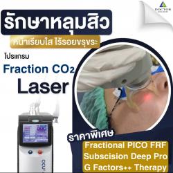 ใหม่ !! โปรคอมโบเลเซอร์ผีลืมหลุม 3,999 ฿ !!