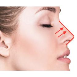 ร้อยไหมล็อคจมูกโด่ง เสริมดั้ง !! Nose Up !! สันชัด ปลายเชิด !!